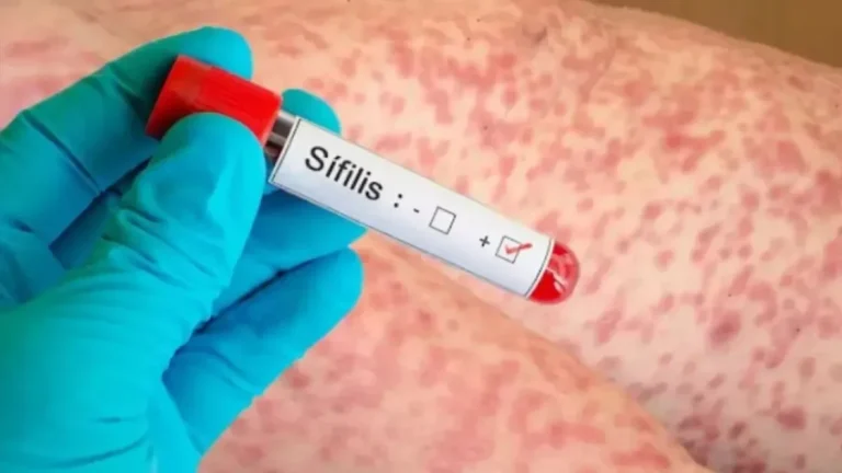 Tucumán lidera el alarmante aumento de sífilis en el NOA con un 52% más de casos
