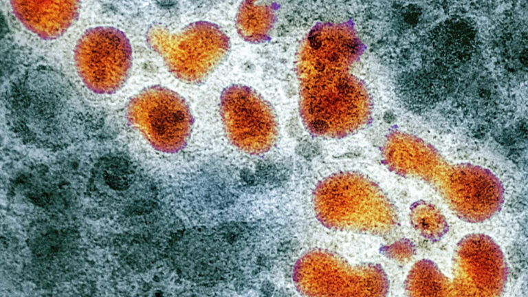 Confirmaron el primer caso de gripe A H3N2 en Tucumán