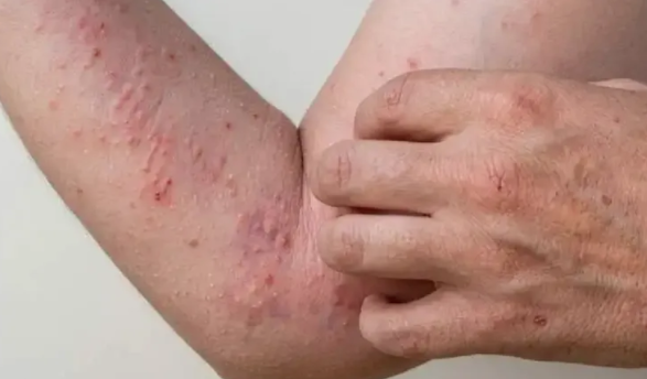 Chikungunya en Tucumán: los casos aumentaron un 60% en una semana