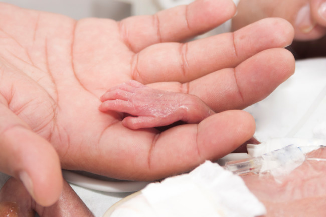 Milagro en la Maternidad: cirujanos tucumanos operaron a una bebé de solo 530 gramos y le salvaron la vida -